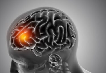 Ictus: cómo evitarlo y superarlo