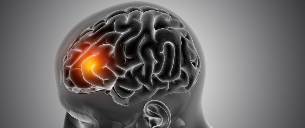 Ictus: cómo evitarlo y superarlo